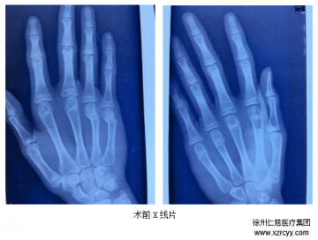 徐州市仁慈醫院微創治療手骨折：無疤痕、恢復快、效果贊